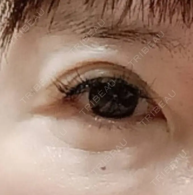 ヒアルロン酸注入（涙袋） AZ BEAUTY CLINIC BEFORE メイン用