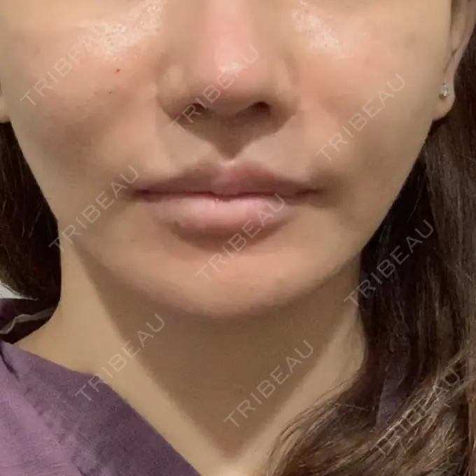 口角挙上 現代美学整形外科 BEFORE メイン用