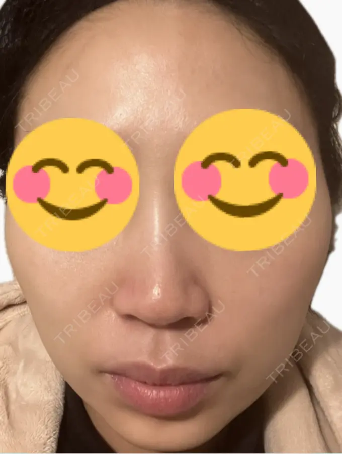 医療脱毛（顔） タイムルクリニック BEFORE メイン用