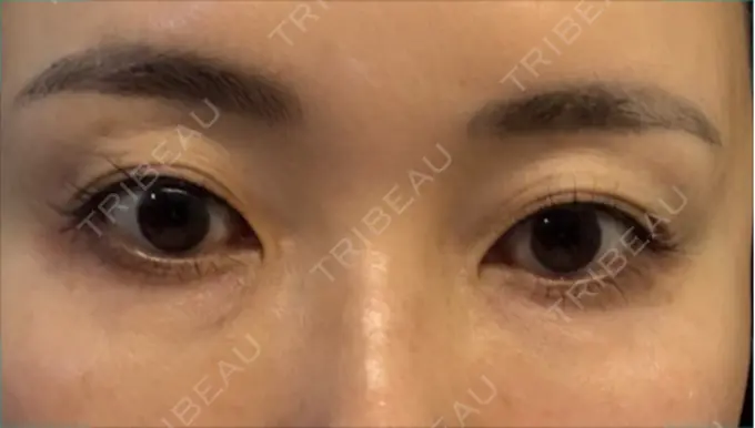 ヒアルロン酸注入（涙袋） / ヒアルロン酸注入（唇） APスキンクリニック銀座 BEFORE メイン用