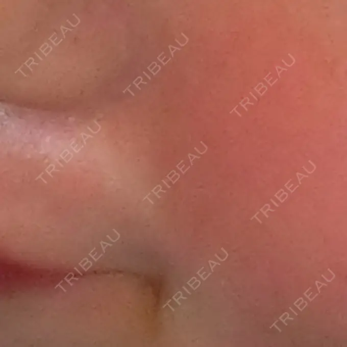 ボトックス（口角） / ヒアルロン酸注入（鼻翼基部） DMTC CLINIC 日本橋院 BEFORE メイン用