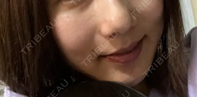 シミ取りレーザー S-Laboクリニック 渋谷院 BEFORE メイン用