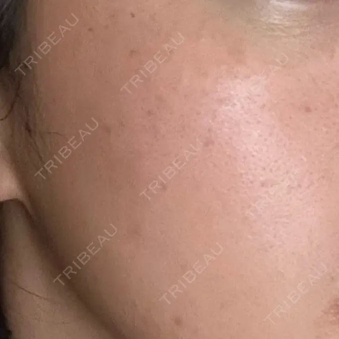 水光注射（ハリ・美肌） 城本クリニック 姫路院 BEFORE メイン用