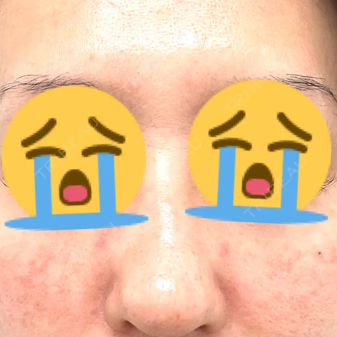 毛穴洗浄（ハイドラフェイシャルなど） / ピコレーザートーニング（美白・肝斑） 日本美容・医療クリニック 六本木院 BEFORE メイン用