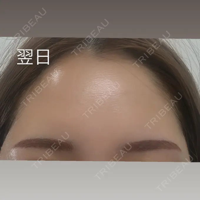 アートメイク（眉） メディカルアートメイク大阪 BEFORE メイン用