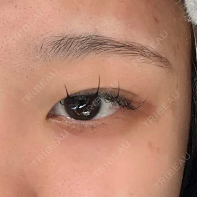 二重埋没 / 目頭切開 HAAB BEAUTY CLINIC 名古屋院 BEFORE メイン用