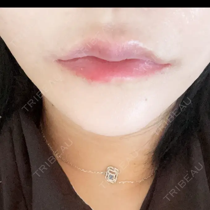 ヒアルロン酸注入（唇） NARU Beauty Clinic 【ナルクリ】 水戸院 BEFORE メイン用