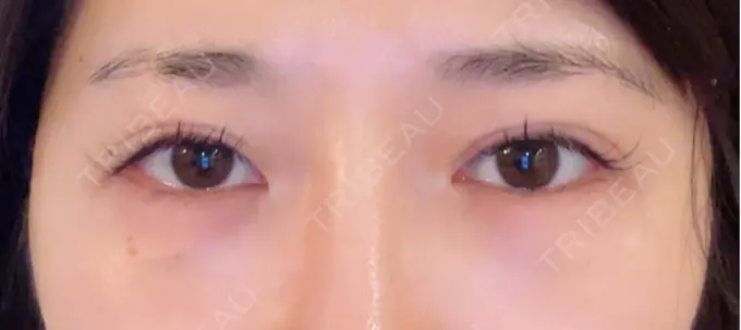 ヒアルロン酸注入（涙袋） ネビュラクリニック 東京錦糸町院 BEFORE メイン用