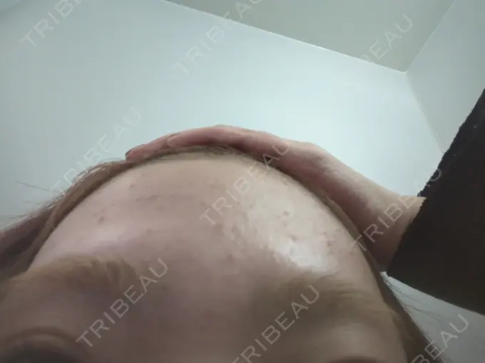 ニードルRF（ポテンツァなど） / ニキビ治療 KM新宿クリニック BEFORE メイン用