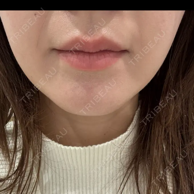 ヒアルロン酸注入（唇） 博多美容外科/美容皮膚科 ビラビューティークリニック BEFORE メイン用