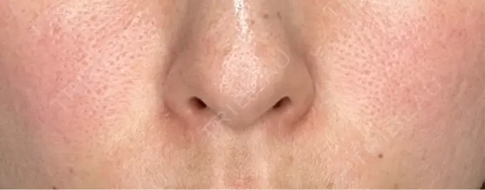 肌ヒアルロン酸注入（たるみ・シワ改善） NARU Beauty Clinic 【ナルクリ】 水戸院 BEFORE メイン用