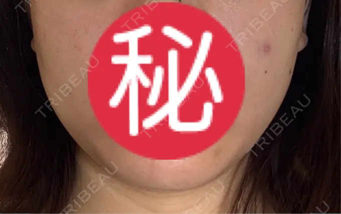 オンダリフト LIGHT CLINIC 【ライトクリニック】 名古屋院 BEFORE メイン用