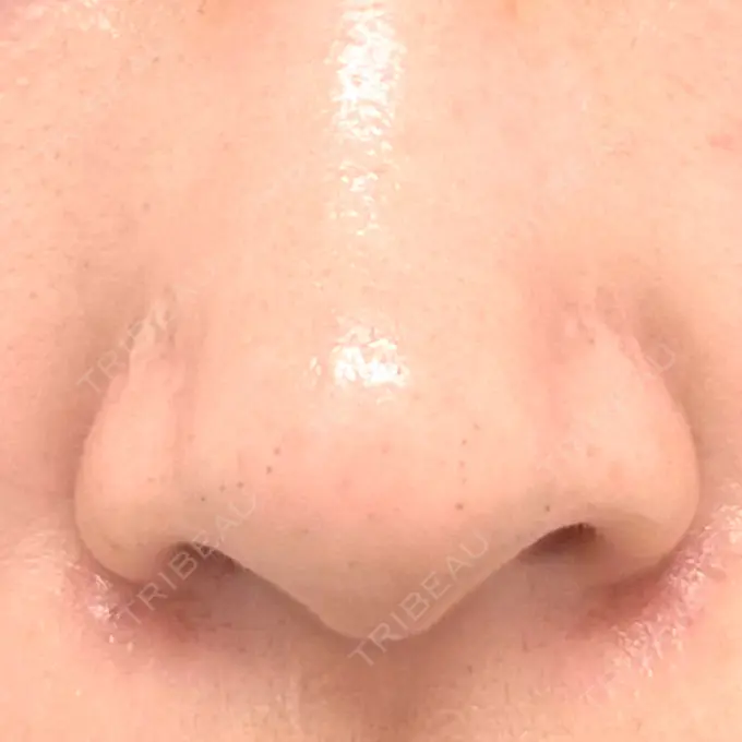 毛穴洗浄（ハイドラフェイシャルなど） 日本美容・医療クリニック 六本木院 BEFORE メイン用