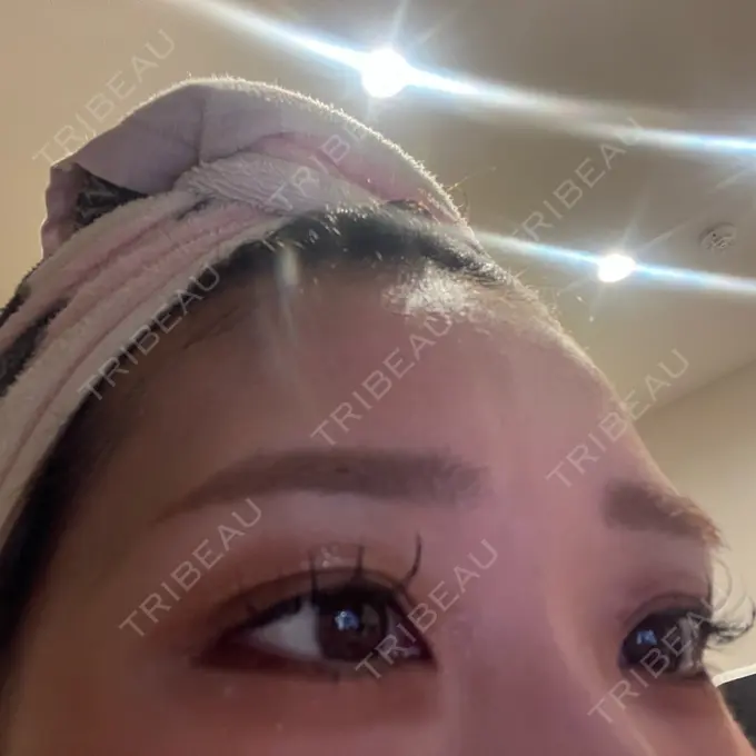 ヒアルロン酸注入（涙袋） / ヒアルロン酸注入（唇） 共立美容外科 京都院 BEFORE メイン用