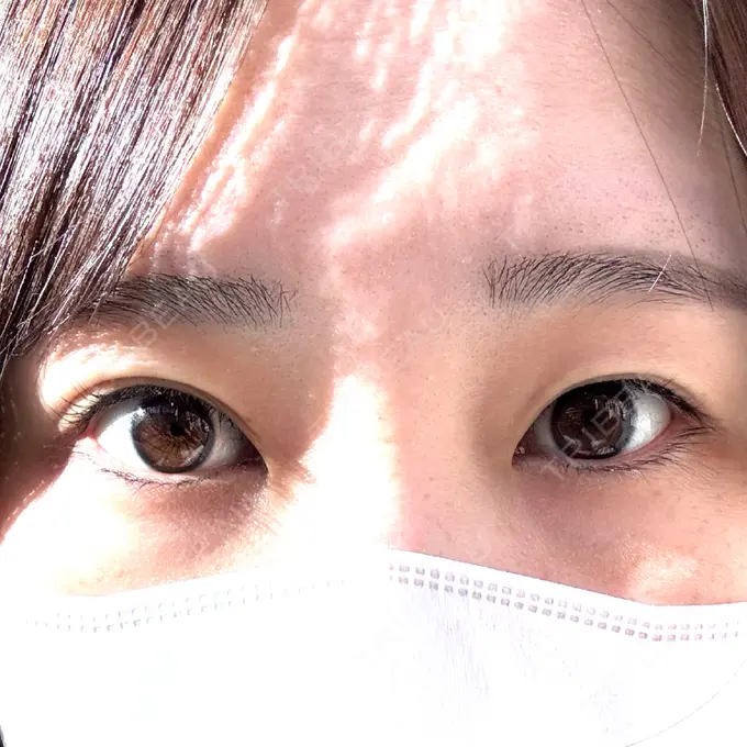 二重埋没 / ヒアルロン酸注入（涙袋） 恵聖会クリニック 京橋院 BEFORE メイン用