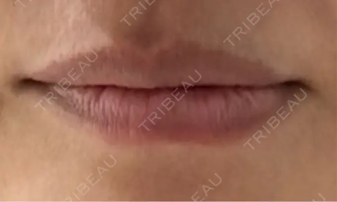 ヒアルロン酸注入（唇） アネシス美容クリニック BEFORE メイン用