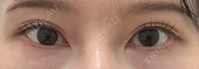 ヒアルロン酸注入（涙袋） TCB東京中央美容外科 名古屋栄院 BEFORE メイン用