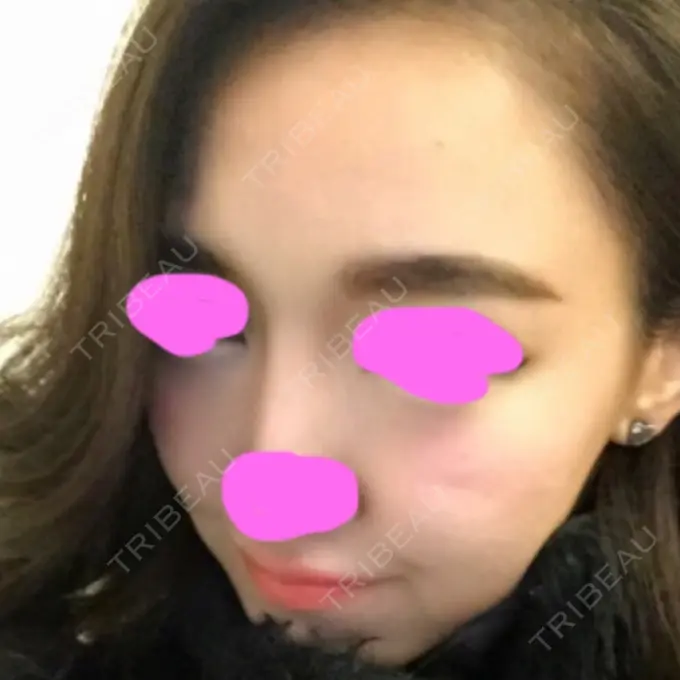 脂肪注入（輪郭） シンデレラ美容整形外科 BEFORE メイン用