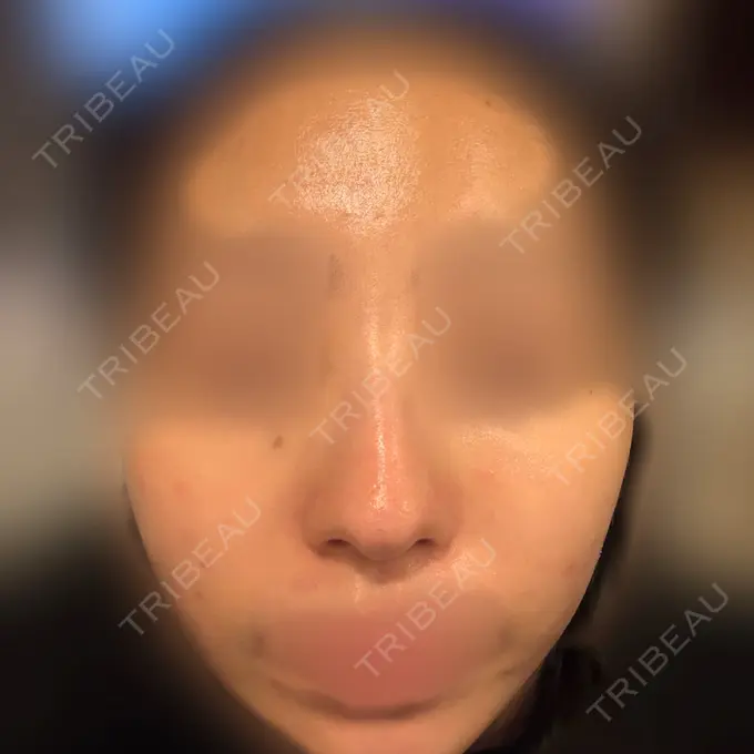 その他（肌） / 光治療（フォトフェイシャルなど） Lumiera Clinic BEFORE メイン用