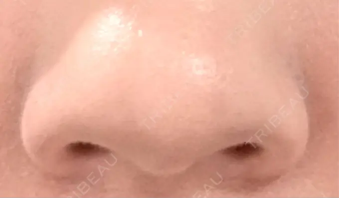 小鼻縮小（切開） くさのたろうクリニック BEFORE メイン用