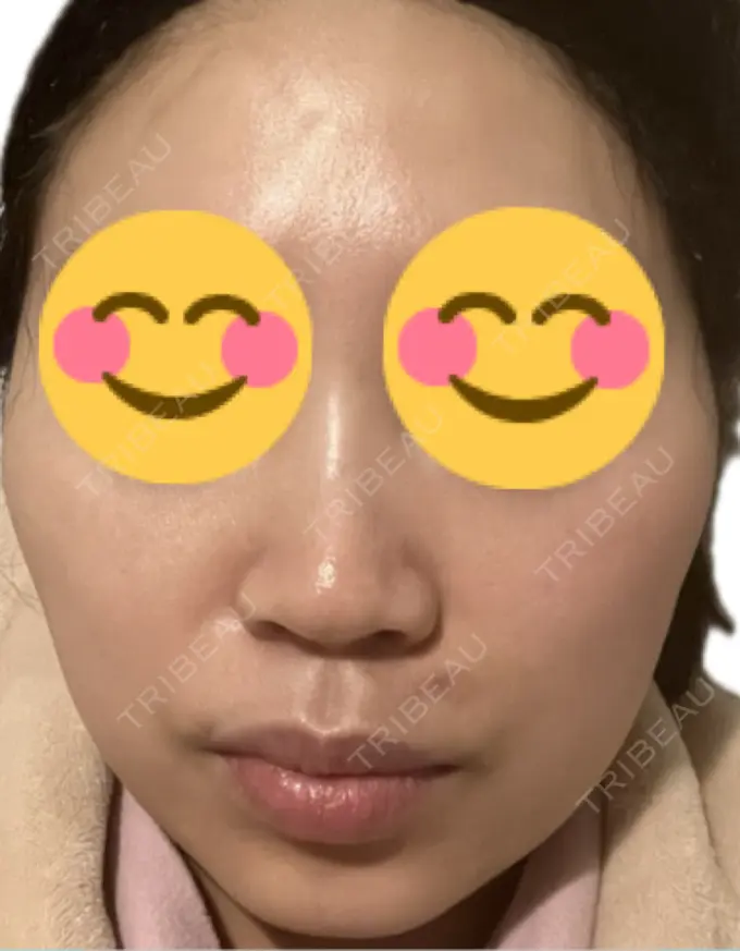 その他（肌） 美容皮膚科エルムクリニック 麻布院 BEFORE メイン用