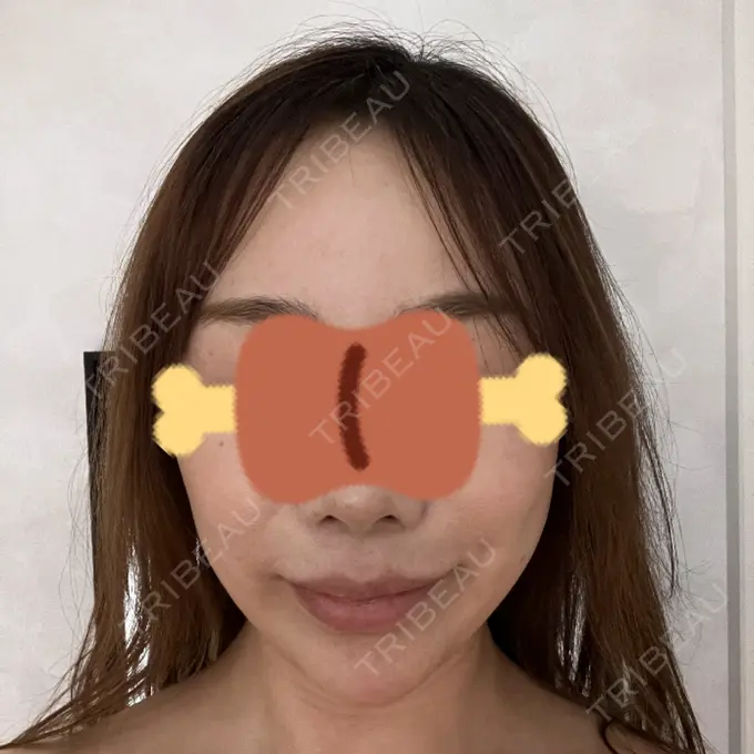 インディバ（顔） WOM SALON【術後ケア取扱いサロン】 BEFORE メイン用