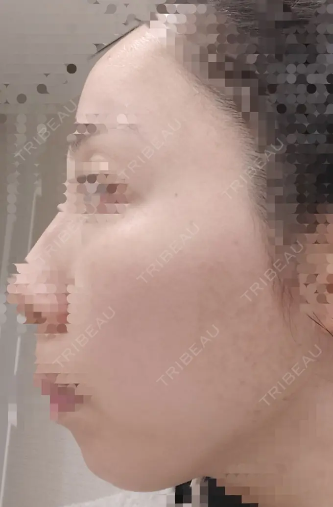 ルビーレーザー AZ BEAUTY CLINIC BEFORE メイン用