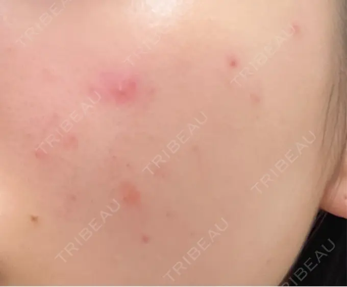 ピーリング（ニキビ・毛穴） / ルメッカ ルラ美容クリニック 大宮院 / ルラスキンクリニック 大宮院 BEFORE メイン用