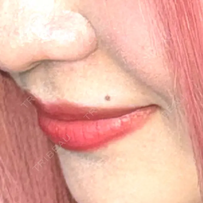 ほくろ・いぼ切除（肌） R Beauty CLINIC 名古屋院 BEFORE メイン用