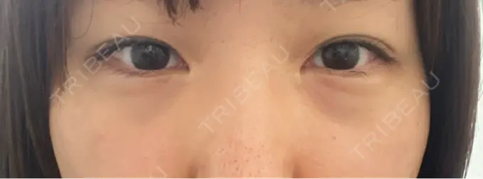 クマ治療 / 下まぶたの脂肪取り 新宿美容外科ネビュラクリニック BEFORE メイン用