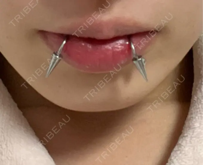 ヒアルロン酸注入（唇） / ボトックス（口角） ルラ美容クリニック 大阪本院 BEFORE メイン用