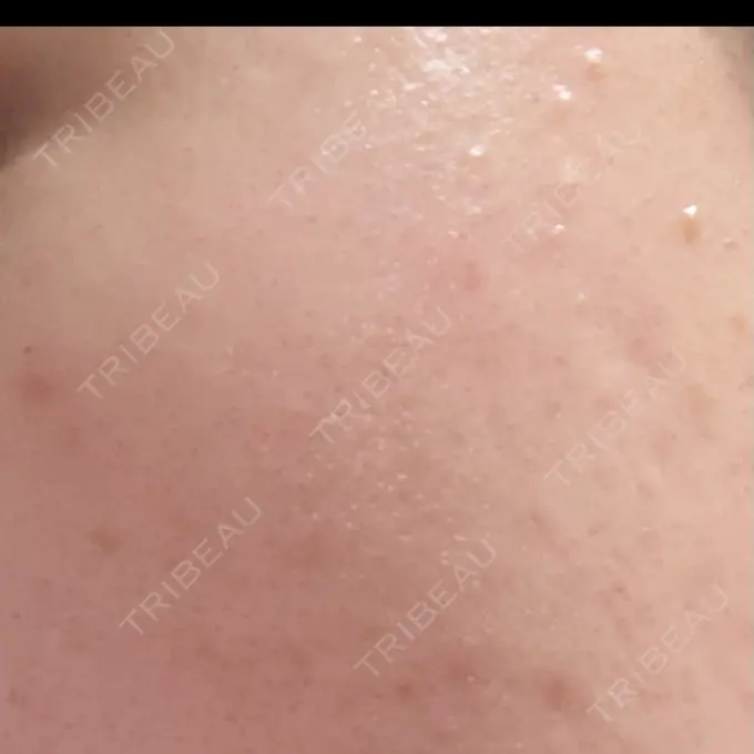 毛穴洗浄（ハイドラフェイシャルなど） さっぽろ美容クリニック BEFORE メイン用