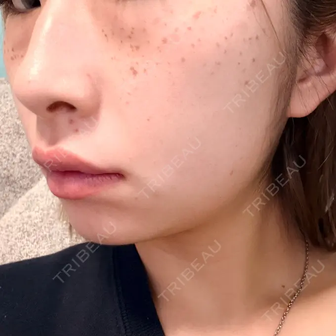 ルメッカ 博多美容外科/美容皮膚科 ビラビューティークリニック BEFORE メイン用