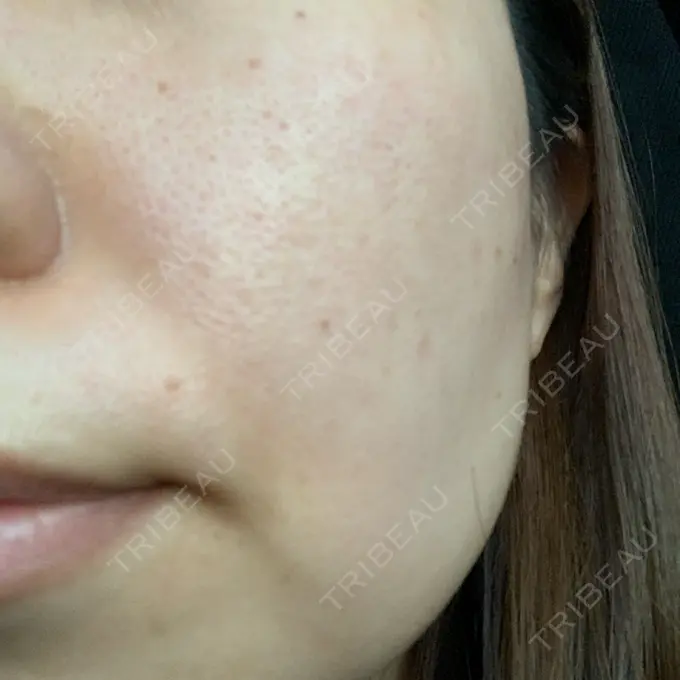 ルメッカ ルラ美容クリニック 大宮院 / ルラスキンクリニック 大宮院 BEFORE メイン用