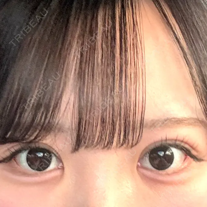 ヒアルロン酸注入（涙袋） ルラ美容クリニック 仙台院 / ルラスキンクリニック 仙台院 BEFORE メイン用