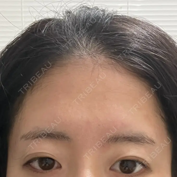 肌育注射（ジュベルックなど） ゆきスキンクリニック 東池袋 BEFORE メイン用