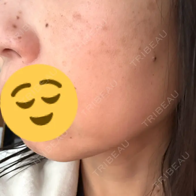 シミ取りレーザー さっぽろ美容クリニック BEFORE メイン用