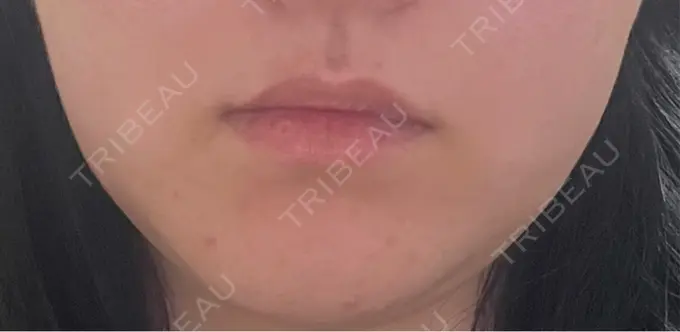 ヒアルロン酸注入（唇） / ボトックス（口角） / インモード 東京美容皮膚科アロエクリニック池袋 BEFORE メイン用