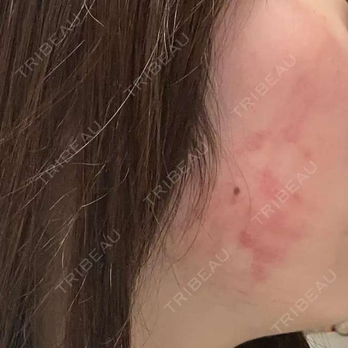 インモード 東京美容皮膚科アロエクリニック池袋 BEFORE メイン用