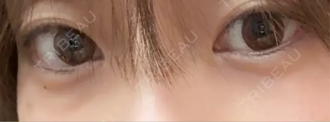 クマ治療 Days Beauty Clinic 新宿院 BEFORE メイン用