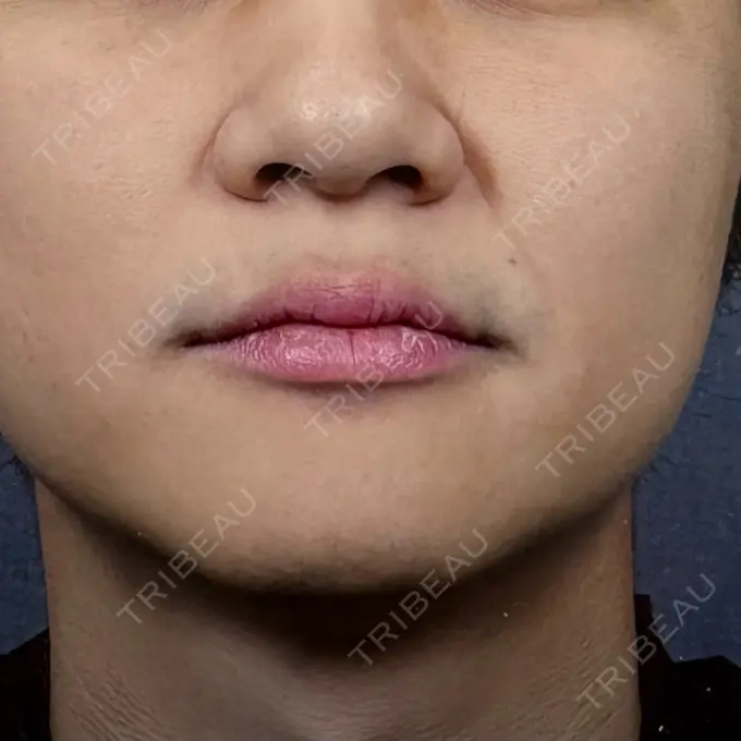 糸リフト / 肌ヒアルロン酸注入（たるみ・シワ改善） アイネクリニック　川崎院 BEFORE メイン用