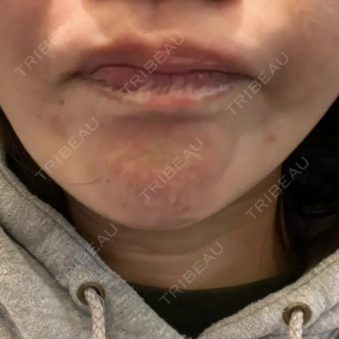 ボトックス（あご） / ボトックス（眉間） / ボトックス（額） 湘南美容クリニック 横浜院 BEFORE メイン用