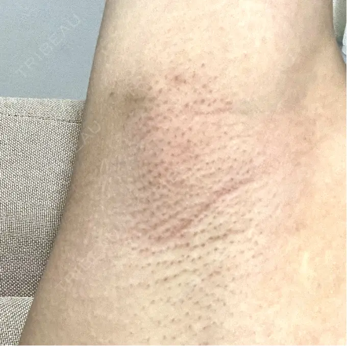 ワキ汗治療（レーザー） ルラ美容クリニック 渋谷本院 BEFORE メイン用