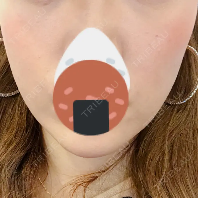 ハイフ（顔） リエンジャン整形外科 江南店 BEFORE メイン用