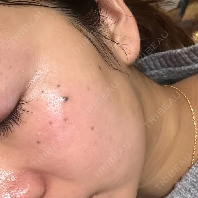 ルメッカ 博多美容外科/美容皮膚科 ビラビューティークリニック BEFORE メイン用