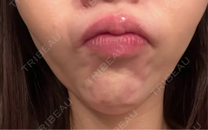 ボトックス（あご） 湘南美容クリニック 名古屋院 BEFORE メイン用