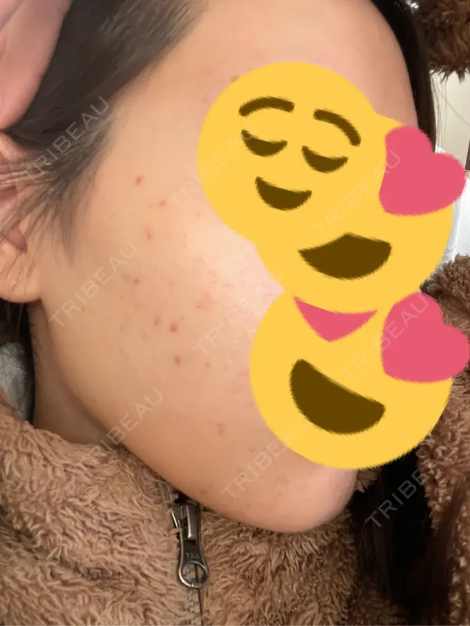 光治療（フォトフェイシャルなど） Fellez Clinic【フェルズクリニック】 BEFORE メイン用