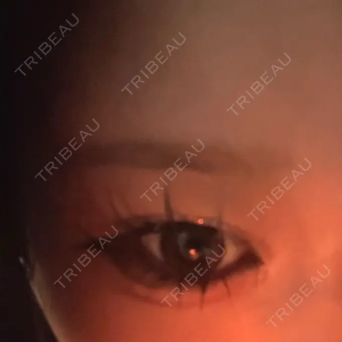 ヒアルロン酸注入（涙袋） 博多美容外科/美容皮膚科 ビラビューティークリニック BEFORE メイン用