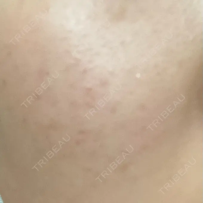 ルメッカ ルラ美容クリニック 岡山院 BEFORE メイン用