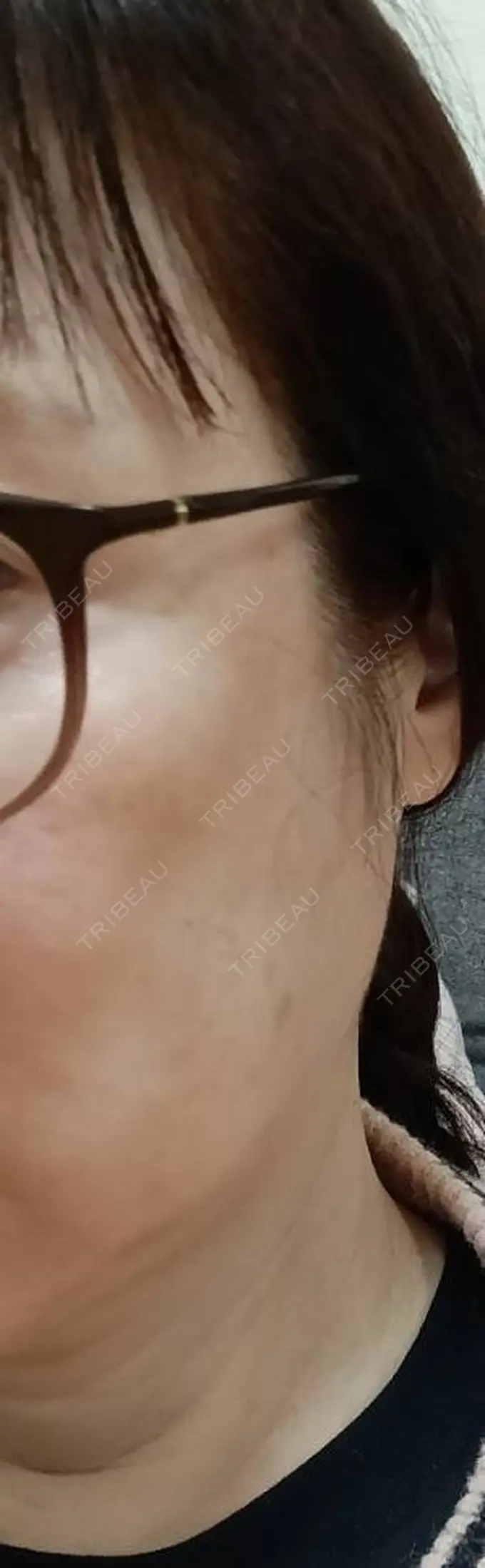 ヒアルロン酸注入（頬） AZ BEAUTY CLINIC BEFORE メイン用